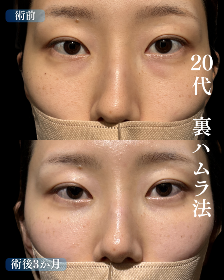 20代女性　裏ハムラ法